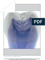 CT Scan Based Finite Element Analysisof Premolar Cuspal Deflection Following Operative Procedures PDF