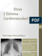 Derrame pericárdico y edema pulmonar en Rx de tórax
