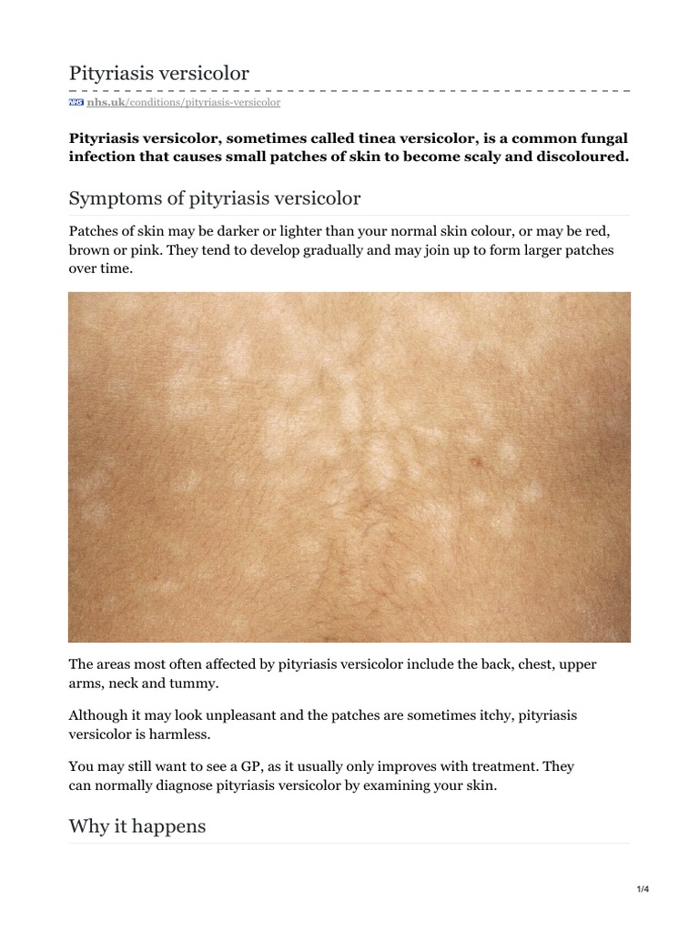 wie-behandelt-man-pityriasis-versicolor-pkexhm