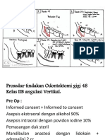 Prosedur Tindakan Odontektomi Gigi 48 Kelas IIB Angulasi