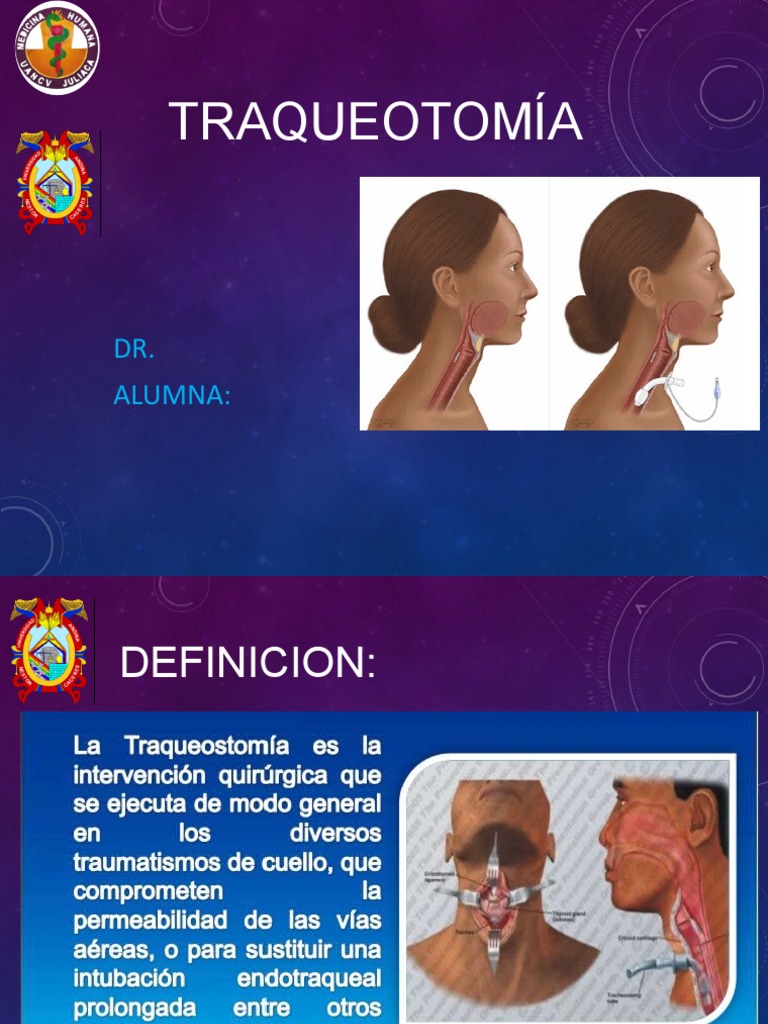 TRAQUEOTOMIA PDF