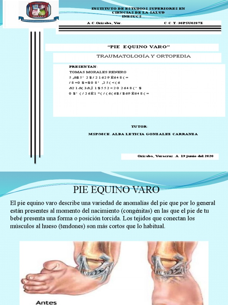 Pie Equino Varo PDF Pie Sistema musculoesquelético