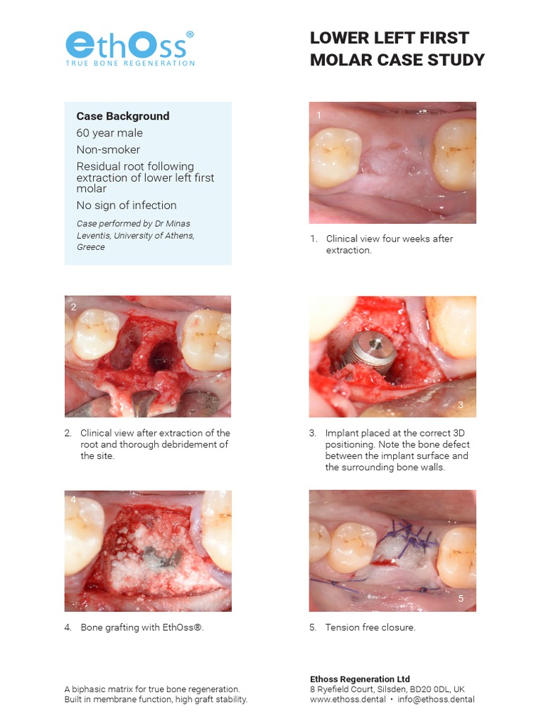 18 Lower Left First Molar Case Study PDF | PDF | Dental Implant ...