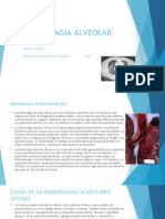 Hemorragia Alveolar Andres Cortes