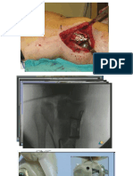 Fracturas de Mesetas Tibiales Tipo V de Schatzker 2