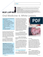 Oral Medicine Update: White Lesions