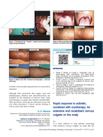 Rapid Response To Acitretin Combined With Cryotherapy For Extensive and Recalcitrant Verruca Vulgaris On The Scalp