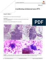 Cytologic Findings of Proliferating Trichilemmal Tumor (PTT) of Scalp