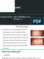 Swollen Gums: Prepared By: Alaa Abdulkareem