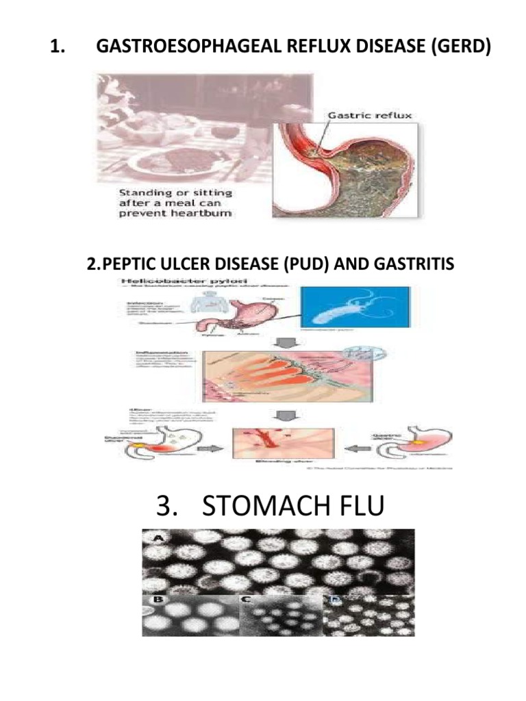 Gastroesophageal Reflux Disease | PDF