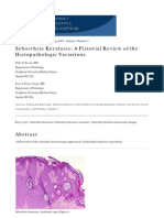 Seborrheic Keratosis: A Pictorial Review of The Histologic Variations
