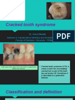 Cracked Tooth Syndrom