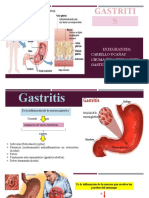 Gastritis Enviar