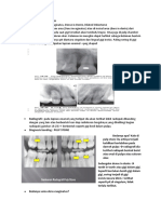 Dens invaginatus diagnosis dan beda dense in dente