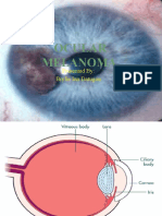 Ocular Melanoma: Presented By: Brylle Ian Datugan