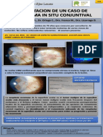 Carcinoma in Situ Conjuntival PDF