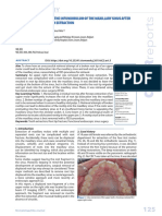 Oral Surgery: Root Tip Migration Into The Infundibulum of The Maxillary Sinus After Complicated First Molar Extraction