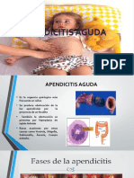 Apendicitis Aguda