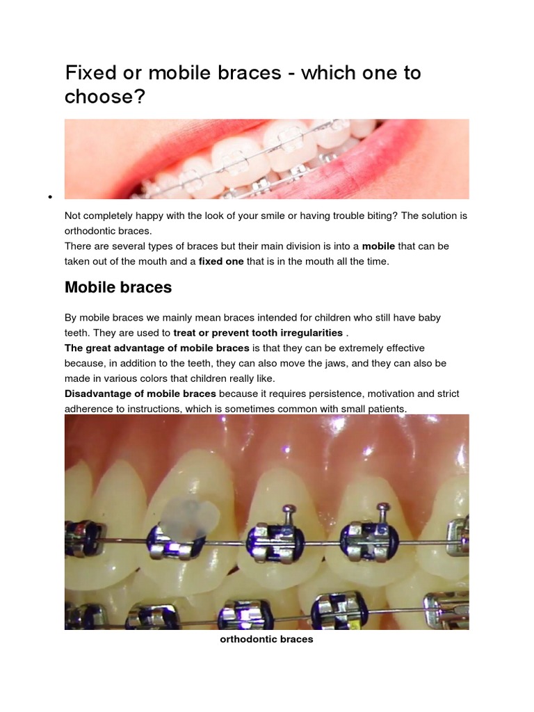 Fixed or Mobile Braces | PDF | Orthodontics | Oral Hygiene