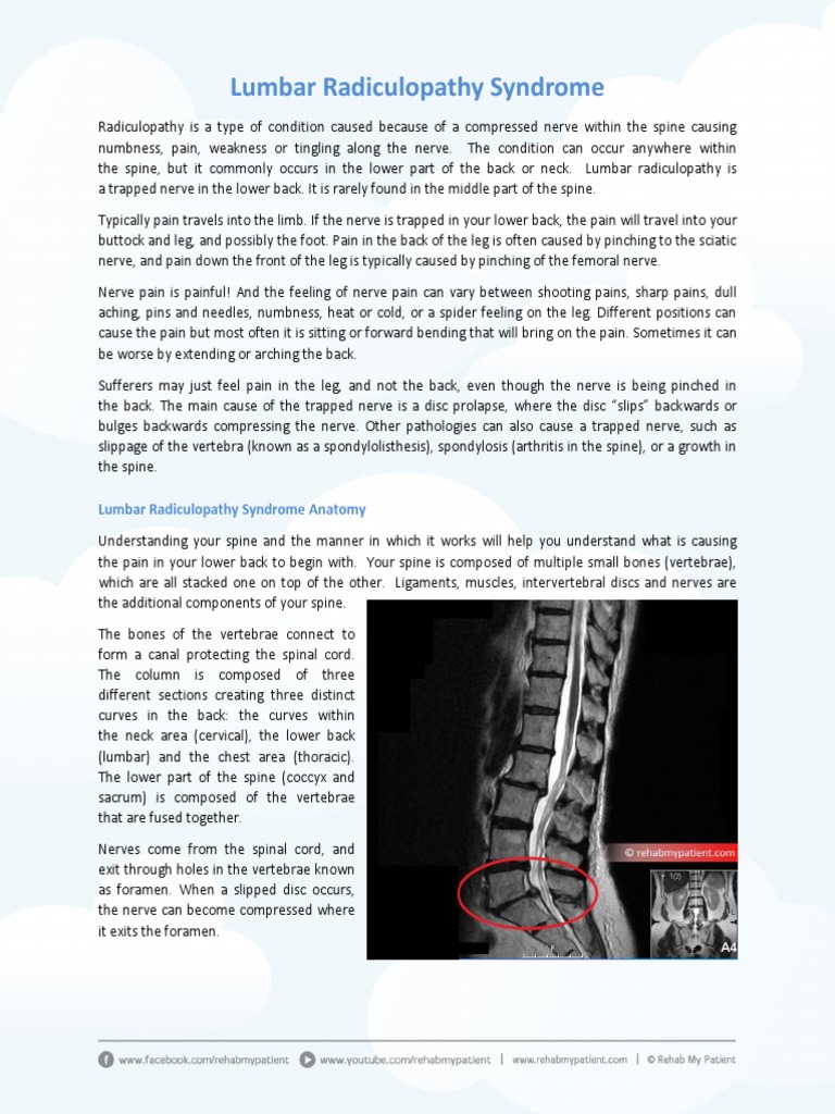 Lumbar Radiculopathy Syndrome Pdf Vertebral Column Spinal Cord