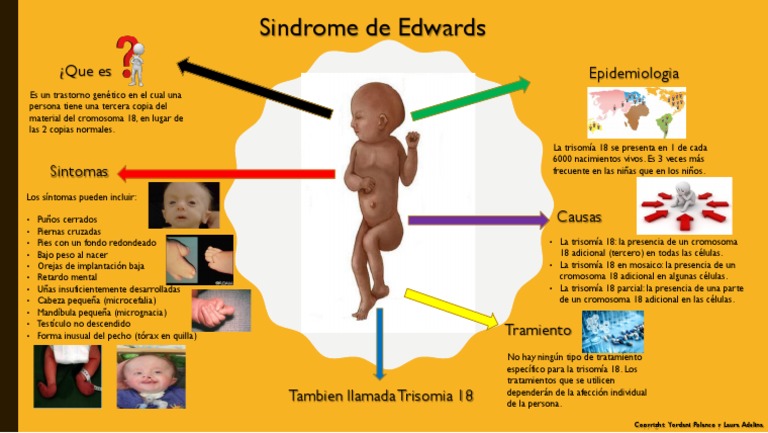 Sindrome De Edwards Adultos Sembrando Esperanza | Síndrome De Edwards