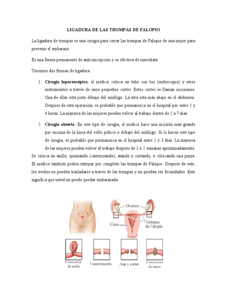 Ligadura Trompas de Falopio | PDF | El embarazo | Reproducción humana