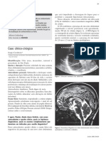 Caso de Hidrocefalia PDF