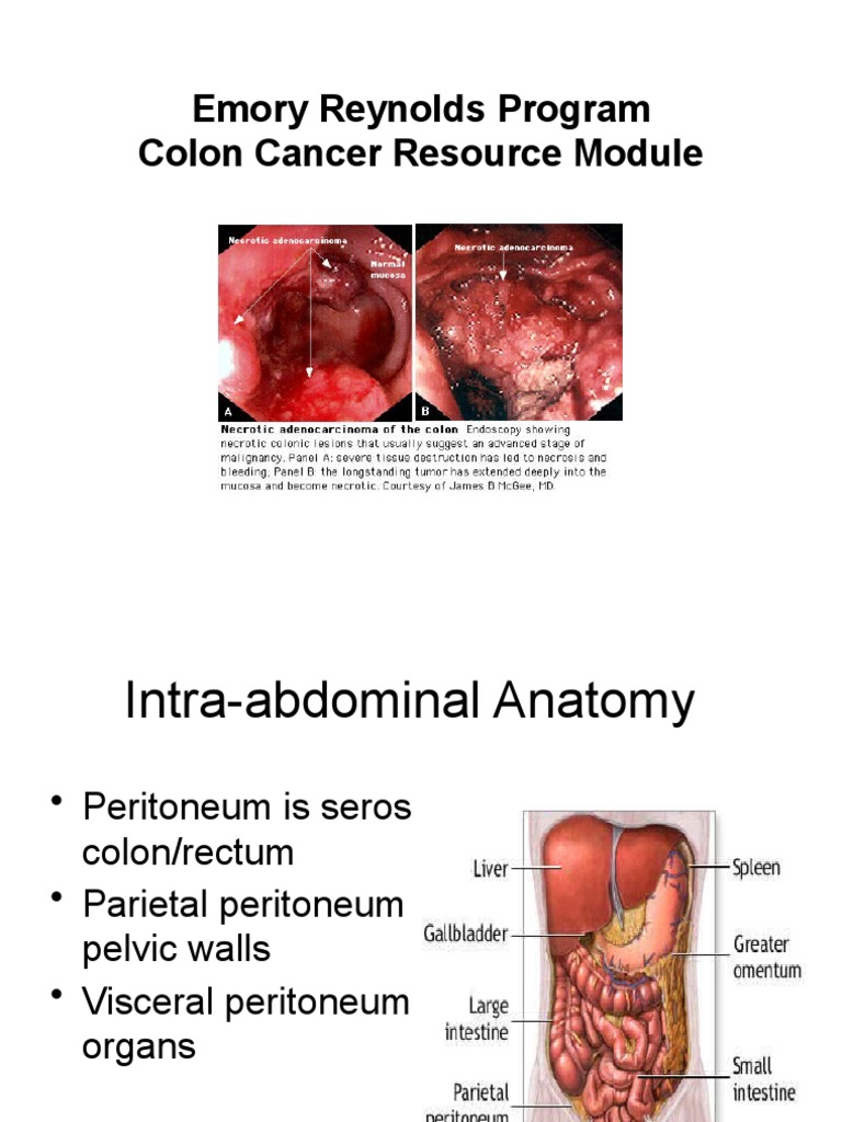 Colon Cancer Overview and Screening Guidelines | PDF | Colorectal ...