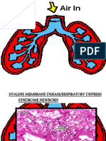 Hyaline Membrane Disease-1