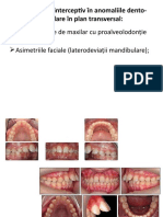 Tratamentul Interceptiv În Anomaliile Dento-Maxilare În Plan Transversal