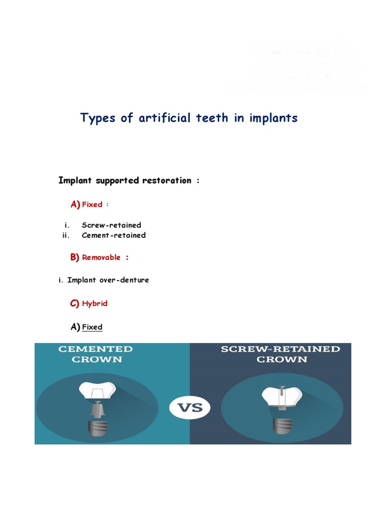 Types of Artificial Teeth in Implants PDF Dental Implant Dentures