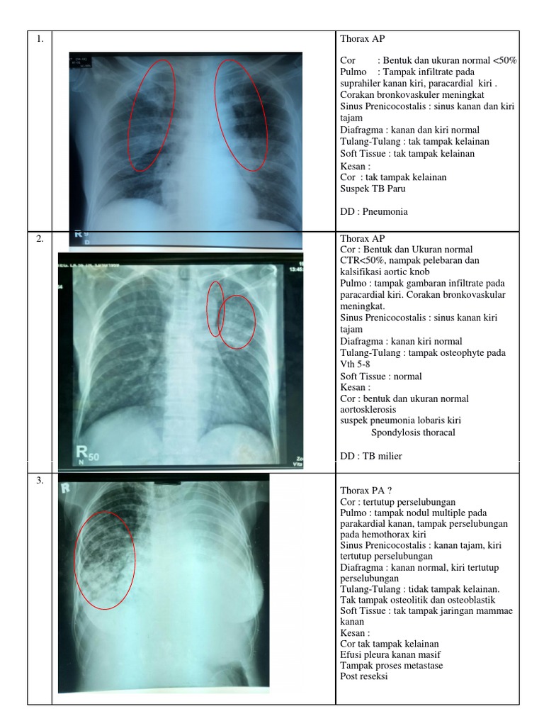 Temuan Radiologi Paru dan Jantung | PDF