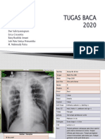 Foto Thorax TB Paru