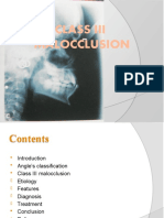 Class Iii Malocclusion: Yeoh Wen Li Iv Year Bds Roll No 35