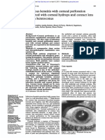 Infectious With Hydrops Lens Keratoconus: Keratitis With Comeal Perforation Associated Comeal and