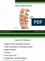 Lumbar Canal Stenosis