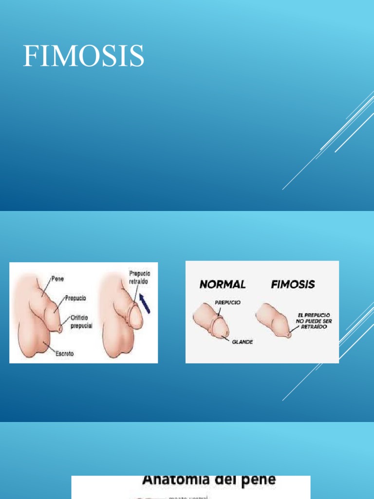 6 Fimosis PDF Circuncisi n Especialidades Medicas