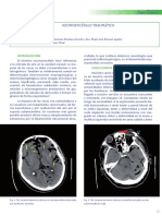 Dialnet-NeumoencefaloTraumatico-5401405.pdf