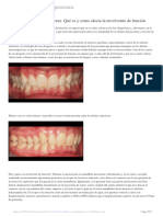 Desgaste en dientes anteriores por constricción de la envolvente de función