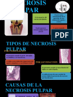 Necrosis Pulpar