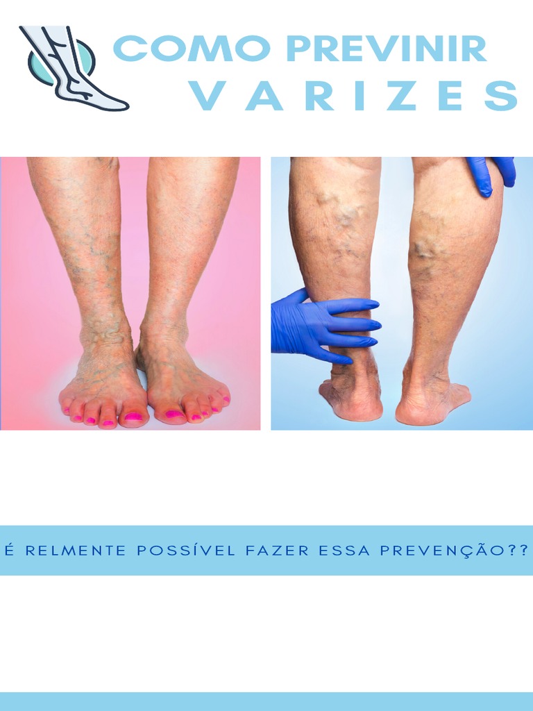Prevenção de Varizes e Estilo de Vida | PDF