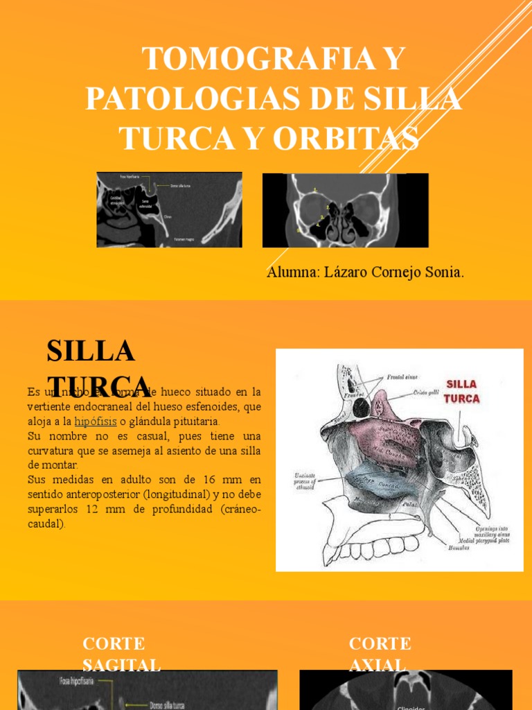 Tomografia de Silla Turca | PDF | Glándula pituitaria | Anatomía de los ...