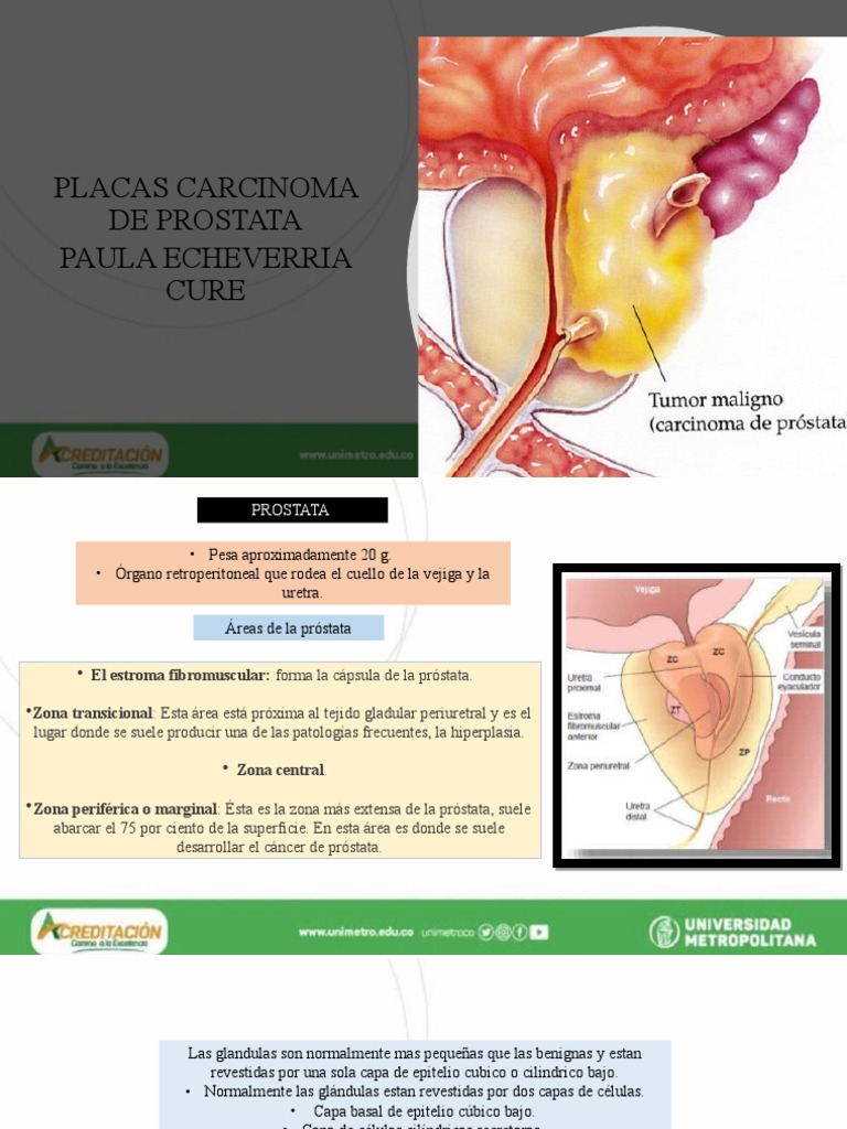 morfología de la próstata xp prostatita si tratament