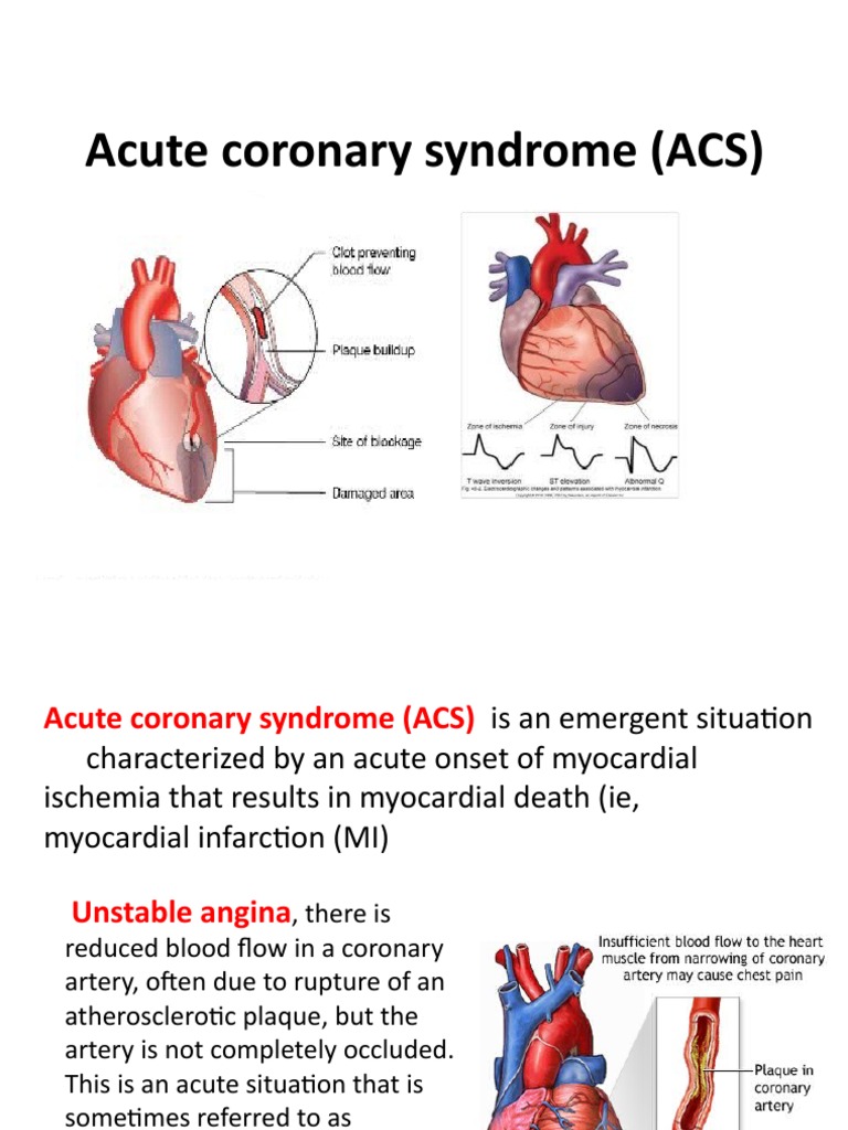 Understanding Acute Coronary Syndrome | PDF | Myocardial Infarction | Heart