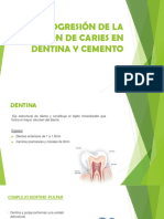 Caries en Dentina y Cemento