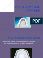 Class IV Kennedy Removable Partial Denture