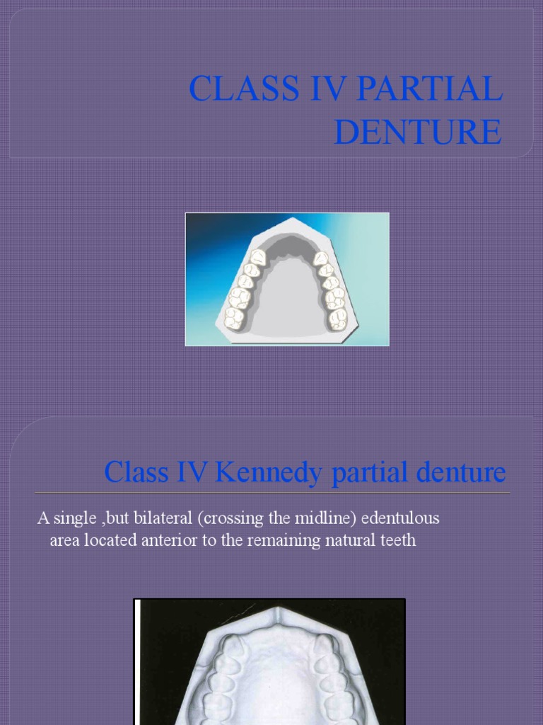 Class IV Kennedy Removable Partial Denture PDF Dentures Mouth