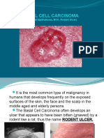 Basal Cell Carcinoma Types, Causes, Symptoms