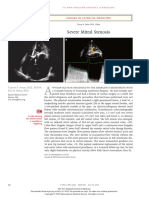 Severe Mitral Stenosis: Images in Clinical Medicine