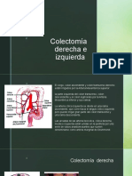 Colectomía derecha e izquierda: descripción de técnica quirúrgica en